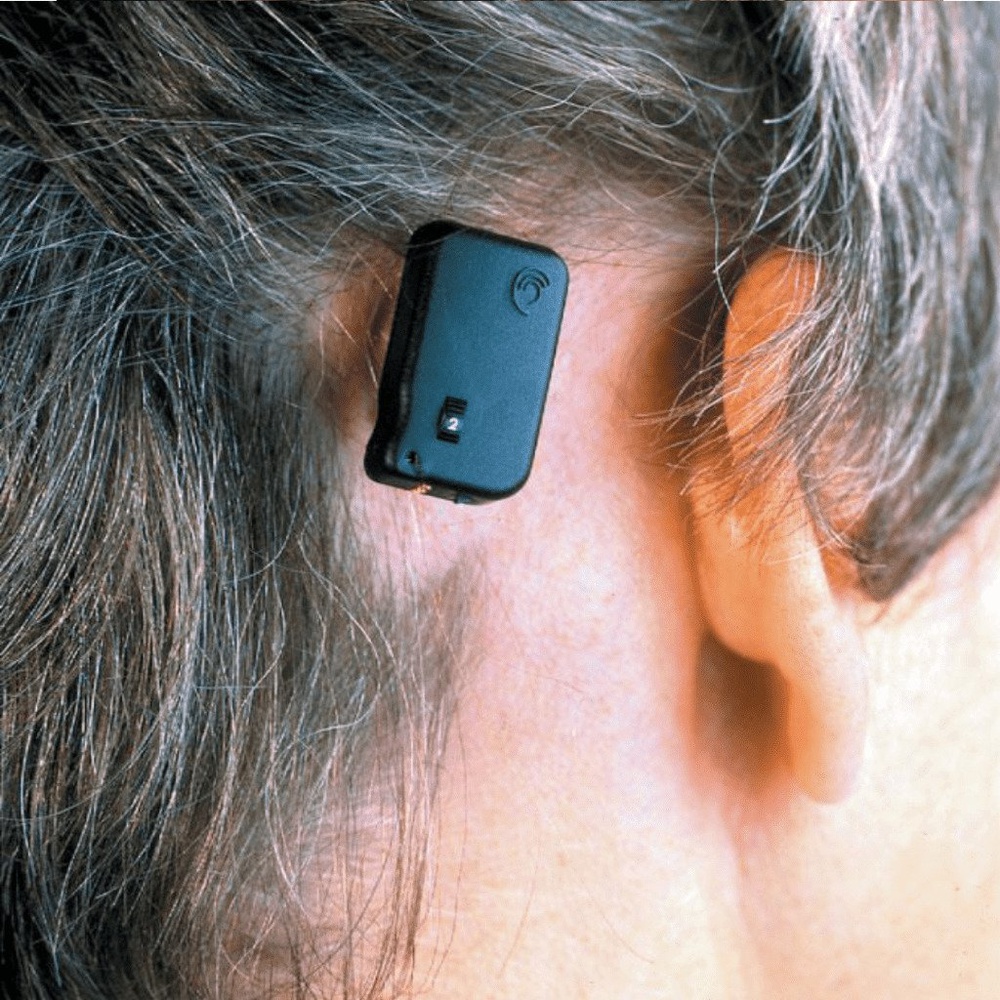 A bone conduction processor attached on top of a bone anchored implant behind the ear.