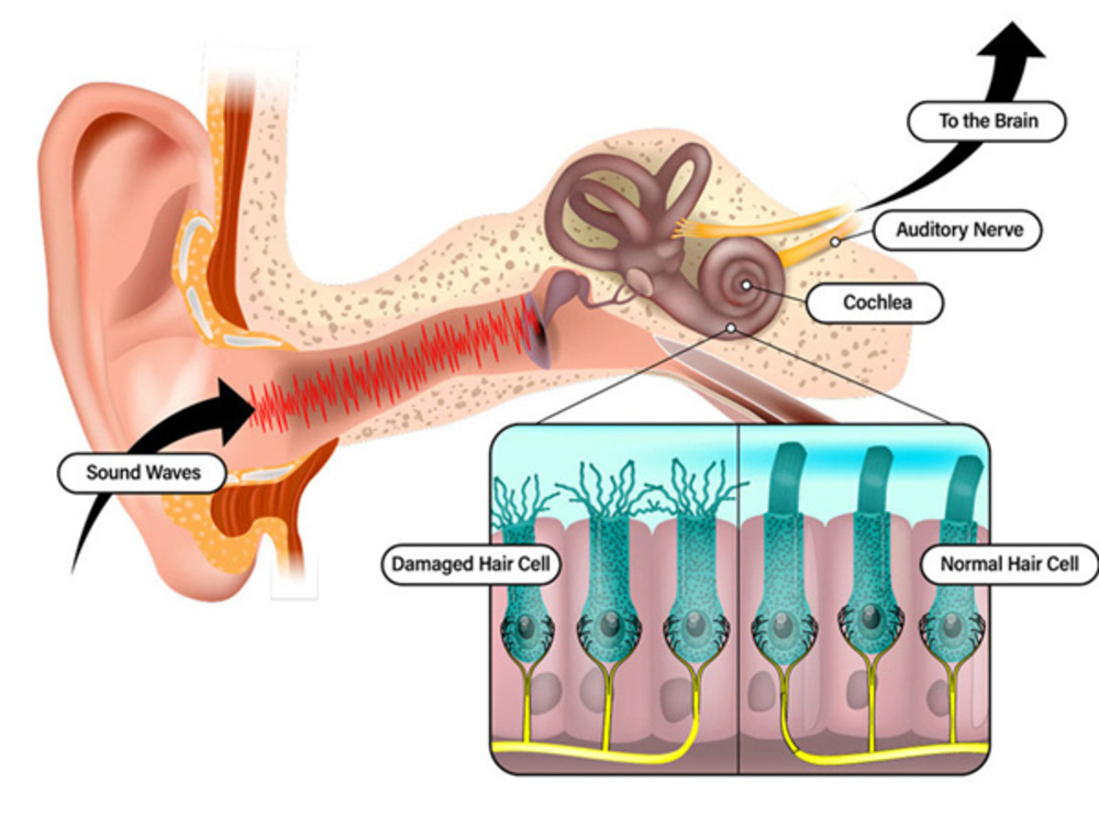 A cross-section of a human ear, with a close of up of the tiny hair cells inside.